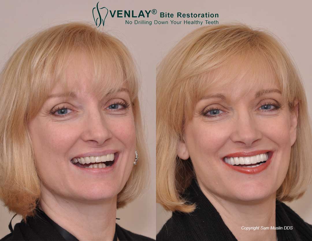 Patient showing a corrected overbite without surgery or braces